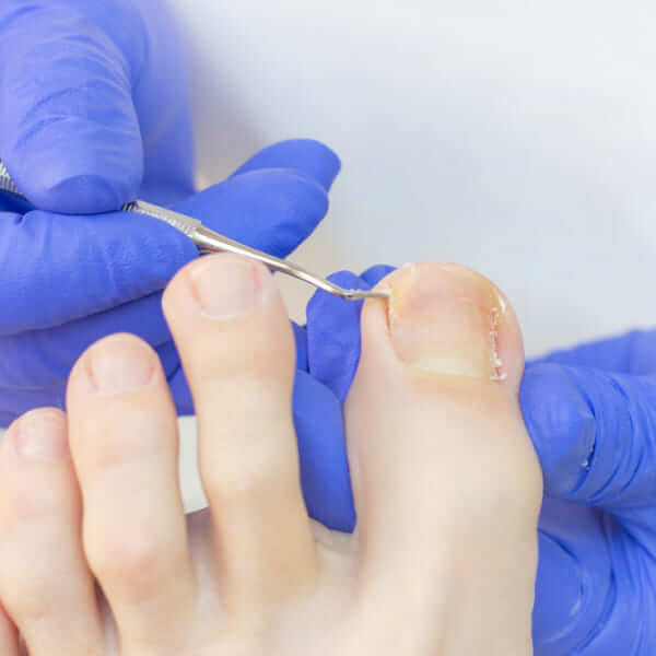 A close-up of a healthcare professional in blue gloves using a specialized metal tool to treat an ingrown toenail on a patient's foot.