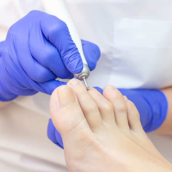 A close-up image of a podiatrist using an electric nail drill to treat a patient's toenail while wearing blue protective gloves.
